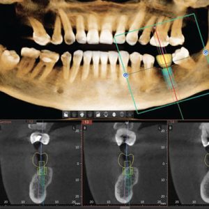 3D-CBCT-snimak