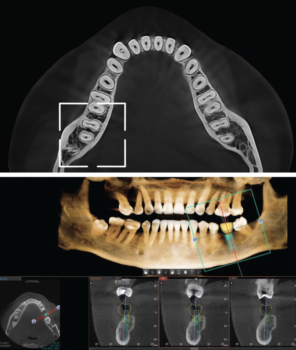 CBCT SEMI - 3D snimak jedne vilice