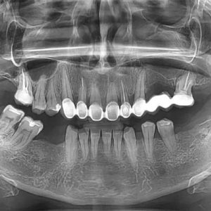 Digitalni-ortopan-snimak