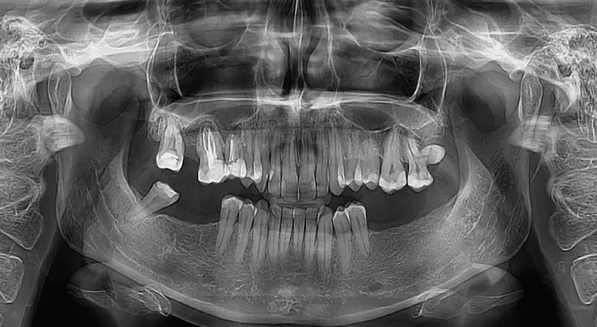 Ortopan snimak – Ortopan tomografija