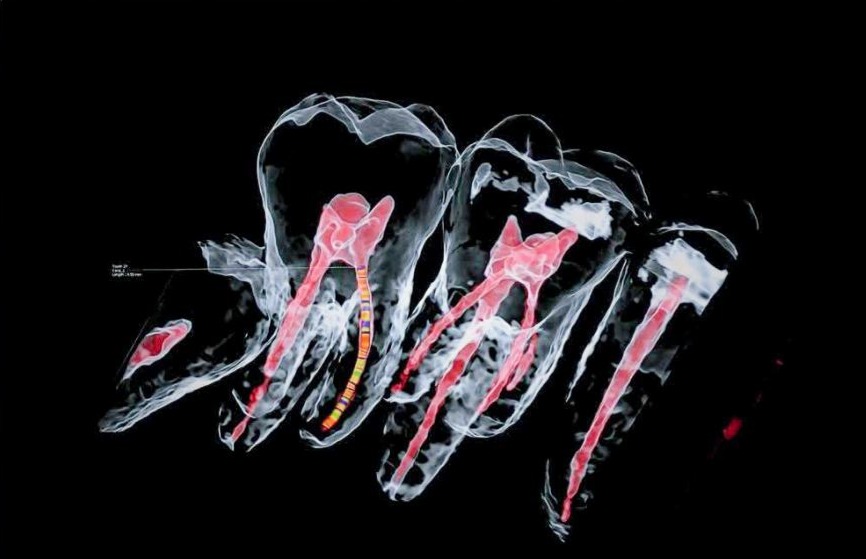 CBCT 3D ENDO snimanje zuba