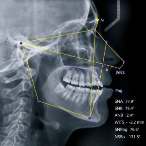 Cefalometrijsko snimanje