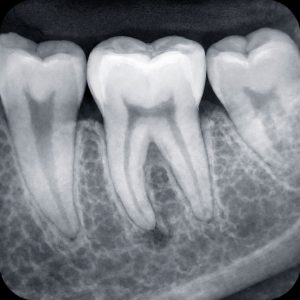 Dentalni radiogram – precizan snimak zuba