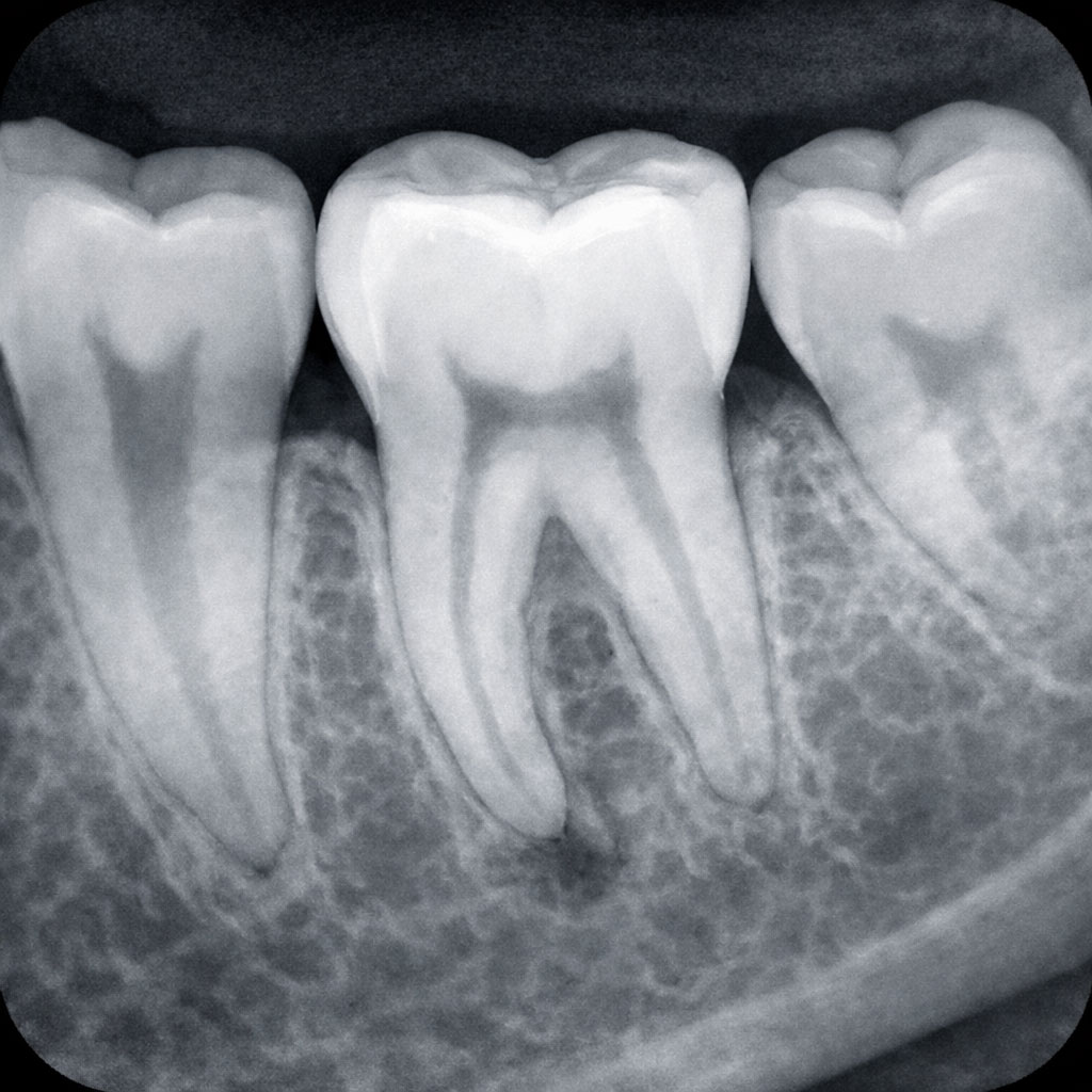 Dentalni radiogram – precizan snimak zuba
