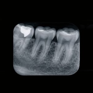 Mali-dentalni-snimak