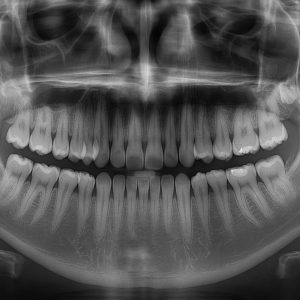 Ortopan-panoramski-snimak-zuba
