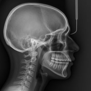 lateralni cefalogram - bočni prikaz glave i vilice
