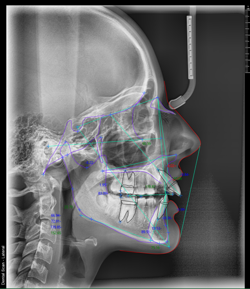 Kefalometrijske analize
