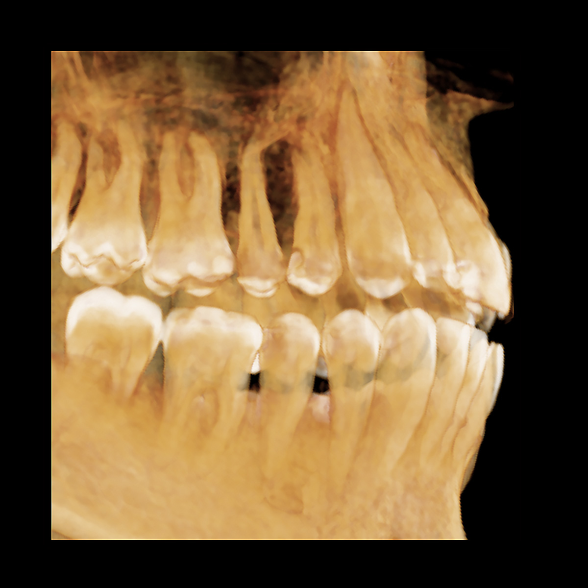 cbct 3d snimak koji prikazuje zube u obe vilice obradjen sa AI