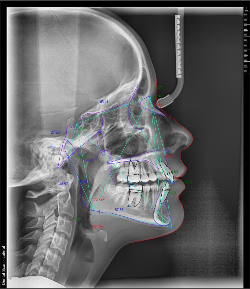 Teleredgen snimak sa ortodontskom analizom