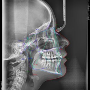 Teleredgen snimak sa ortodontskom analizom