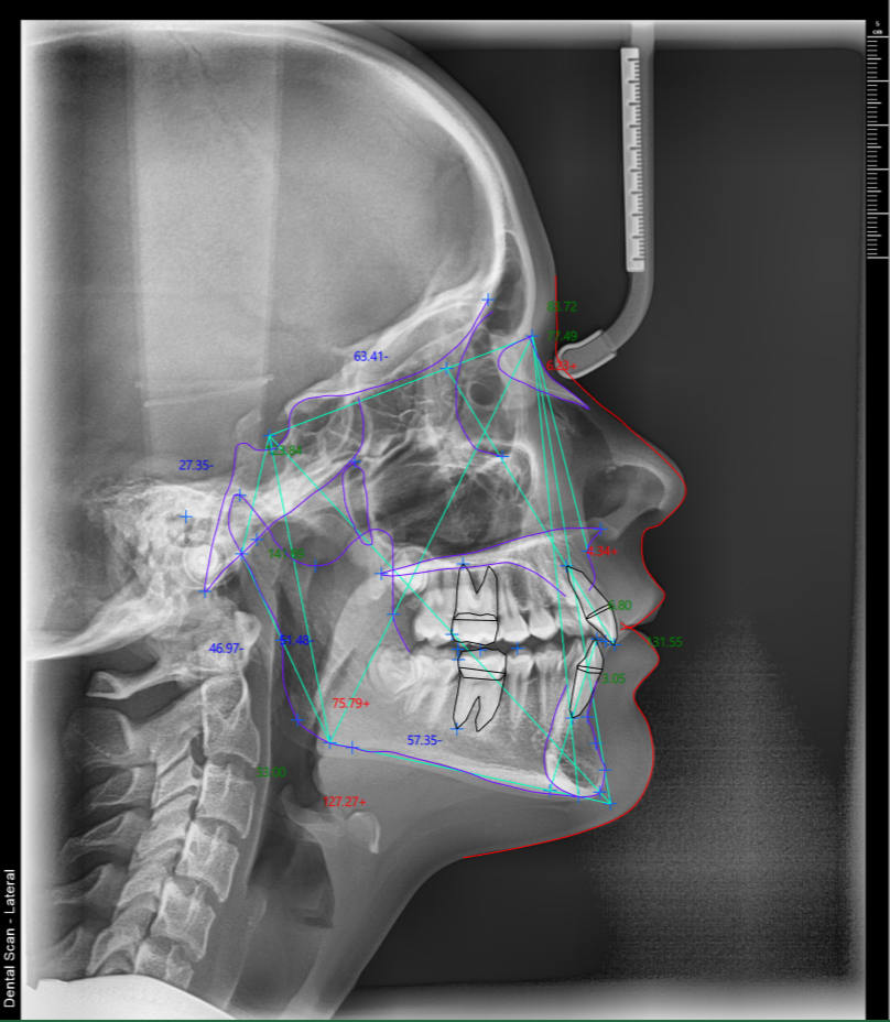 Telerendgen profilna analiza