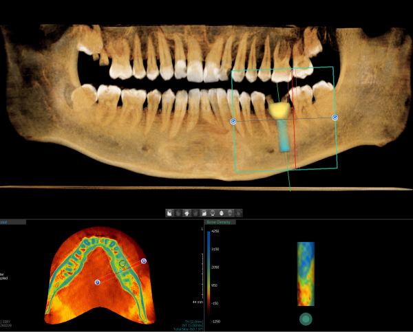 3D snimak zuba za planiranje implantata