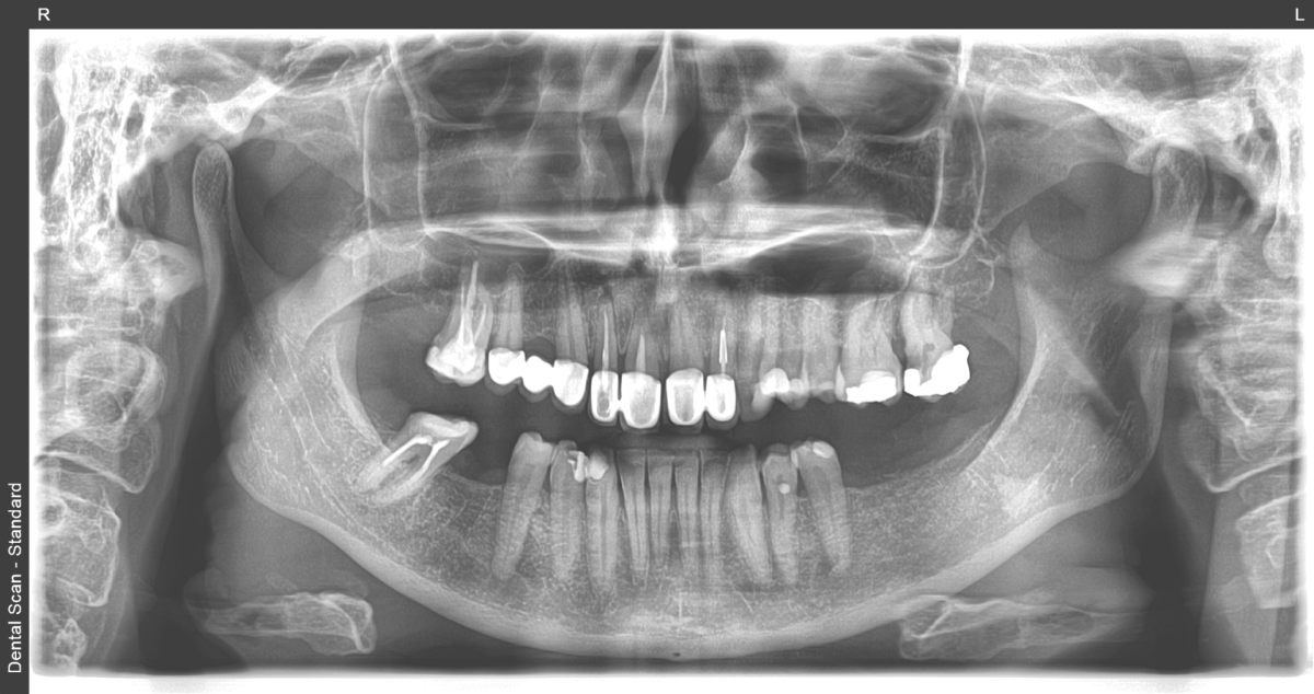 Ortopan - Panoramski snimak zuba, Dental Scan Beograd