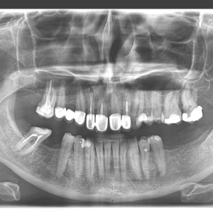 Ortopan - Panoramski snimak zuba, Dental Scan Beograd