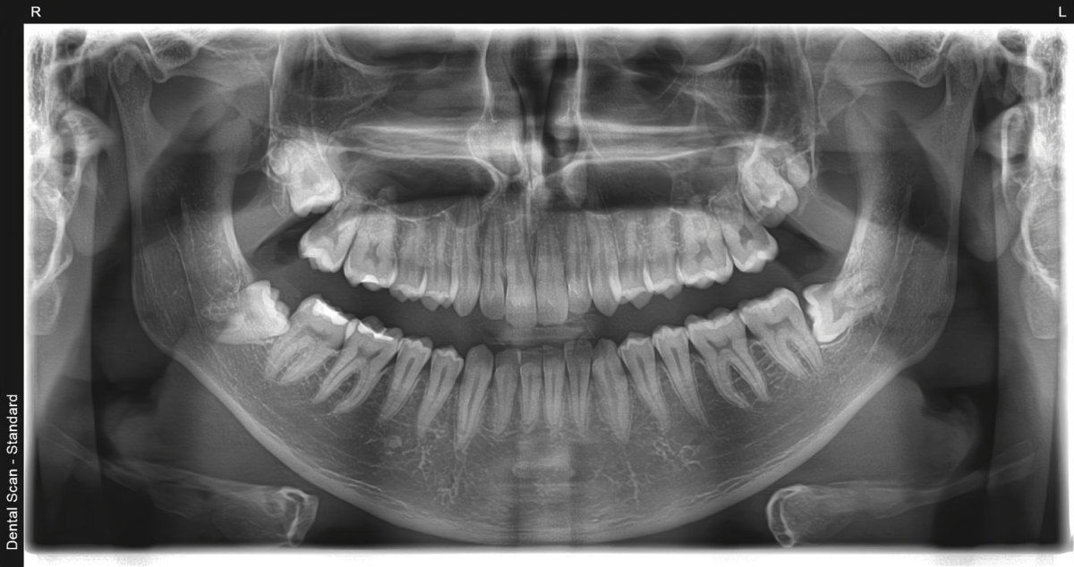 panoramski-snimak-vilice-ortopan-dijagnostika