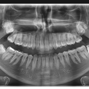 Ortopan snimak zuba u Dental Scanu, centar za snimanje zuba Beograd