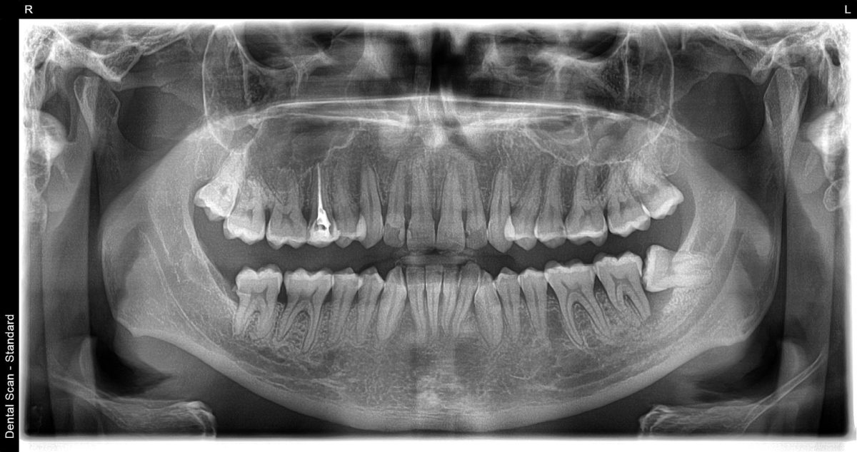 Ortopan snimak Stari Grad