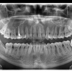 Ortopan snimak Stari Grad