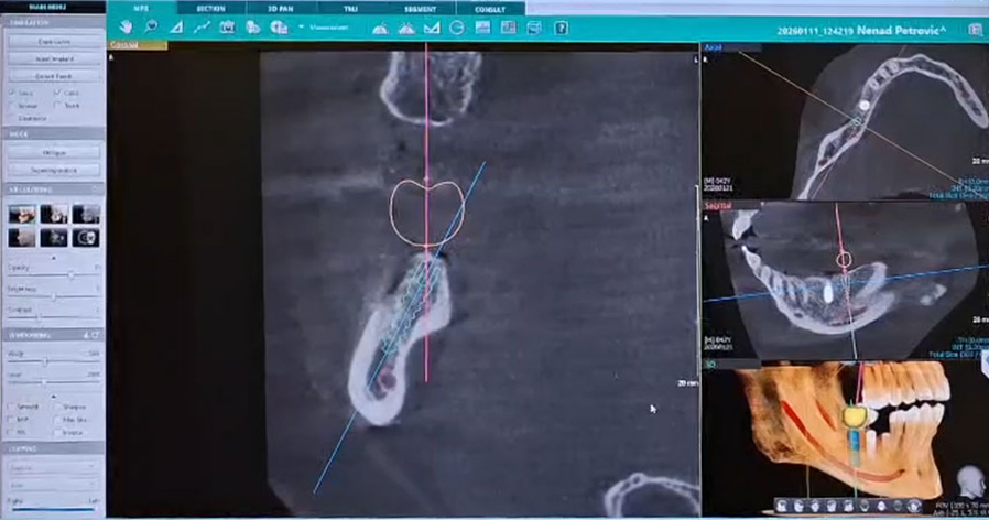 Planiranje-implantata-i-3D-simulacija