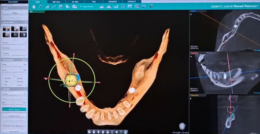 Planiranje implantata u 3D CBCT softveru — analiza pozicije iz svih uglova