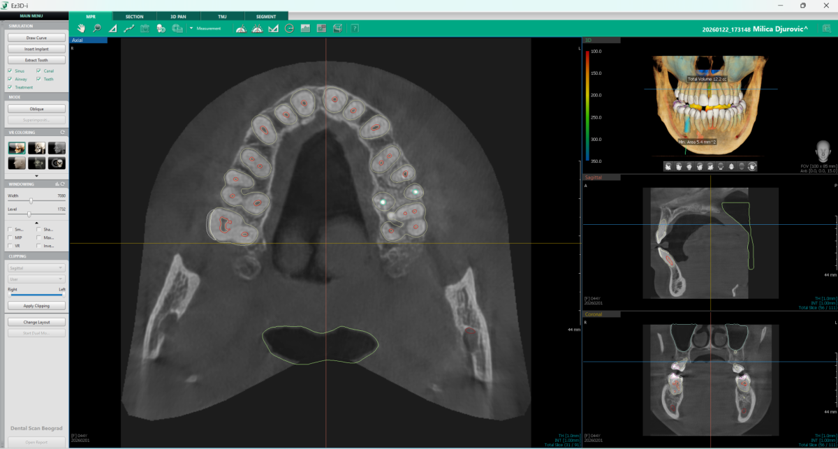 3d snimak zuba koji prikazuje sve zube sa okolnim strukturama