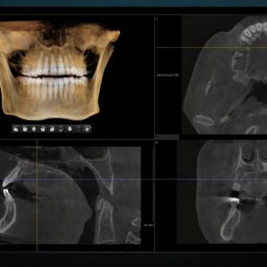 3d snimak zuba prikaz u više racvni