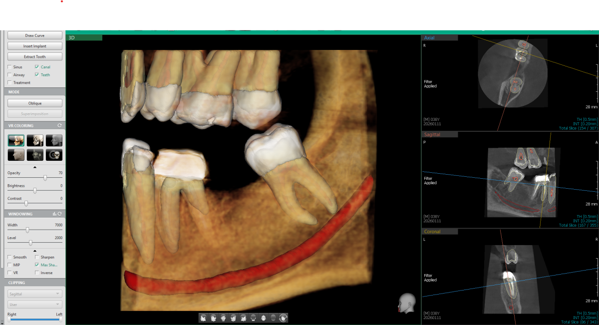 3d snimak zuba za ugradnju implatata, Dental Scan Beograd