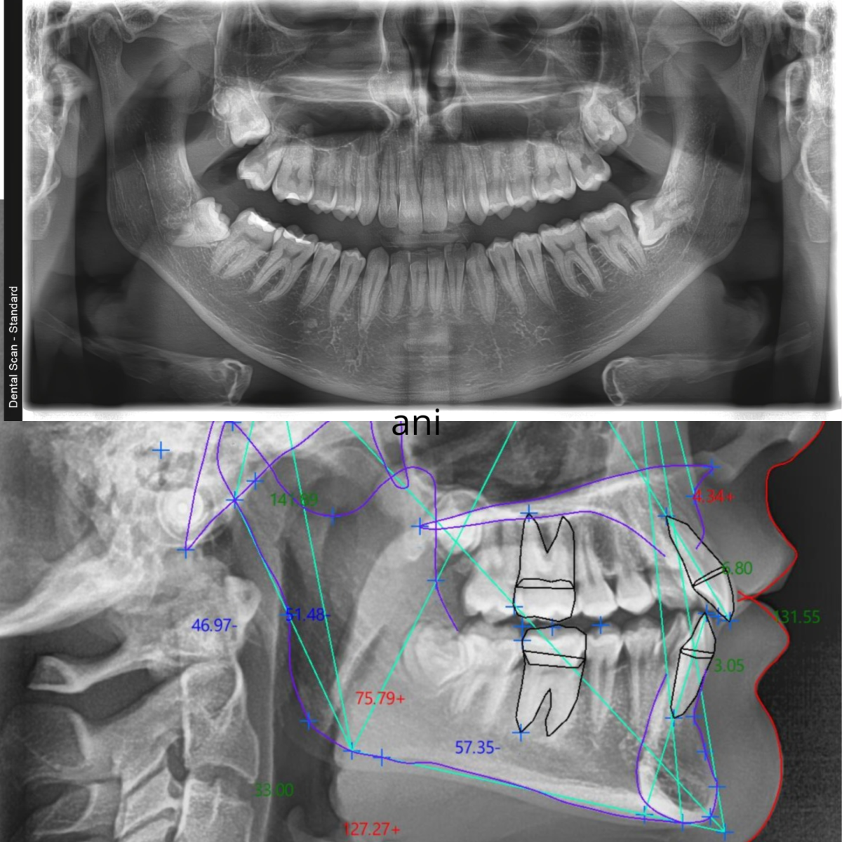 Digitalni ortopan i telerendgen snimak po nalogu ortodonta