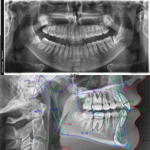 Digitalni ortopan i telerendgen snimak po nalogu ortodonta