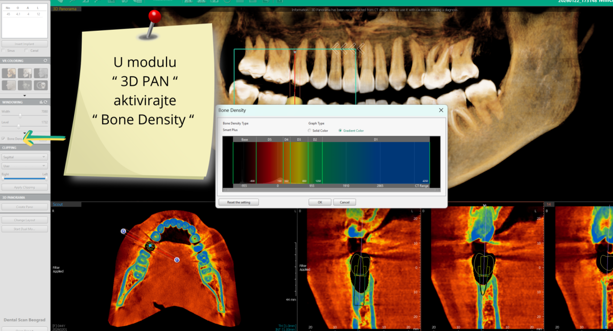 Merenje gustine kosti u programu za analizu 3d snimka, Dental Scan Beograd, centar za 3d snimanje zuba