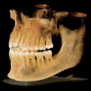 3d cbct snimak zuba obe vilice za postavljanje dijagnoze
