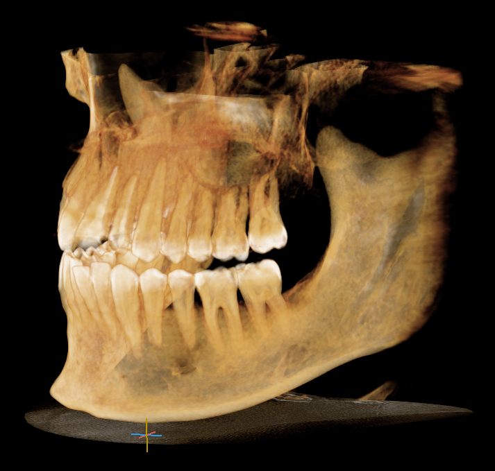 3D CBCT snimak zuba — trodimenzionalni prikaz obe vilice