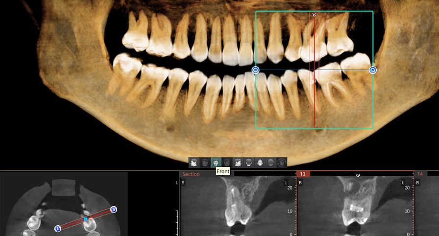 CBCT snimak