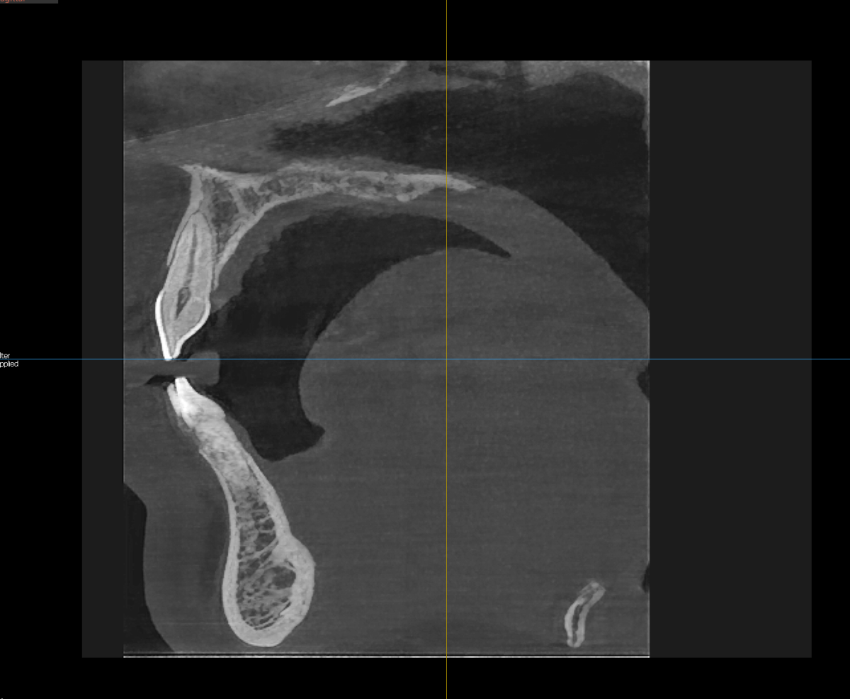 cbct snimak zuba obrada