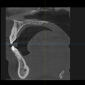 cbct snimak zuba obrada