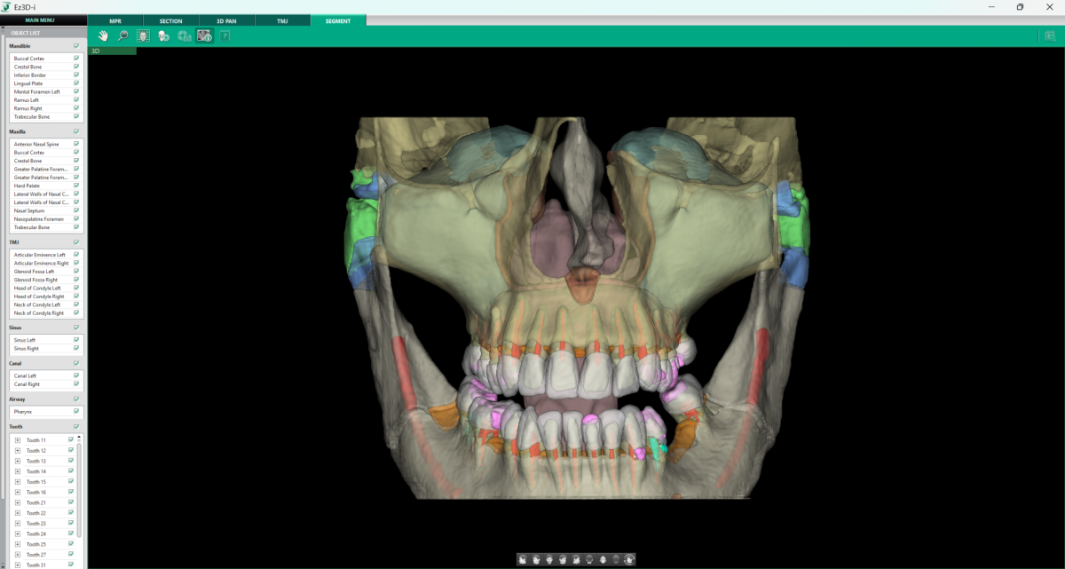 cbct snimak maksilarnog sinusa, 3d snimanje sinusa
