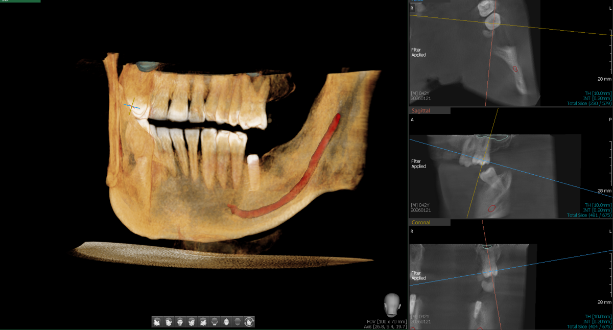 CBCT Semi 3D snimak jedne vilice — Dental Scan Beograd
